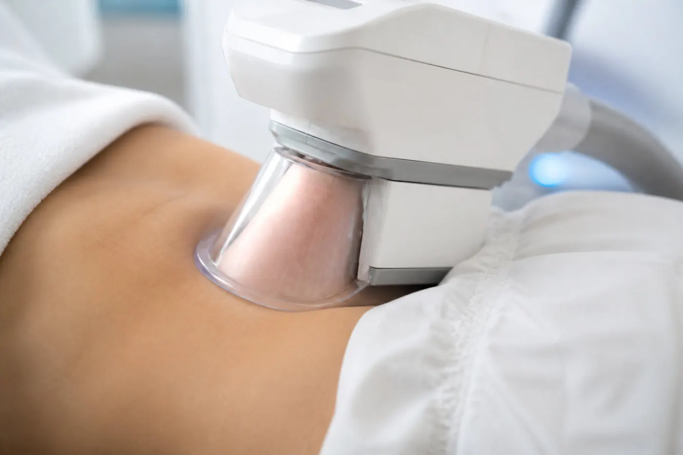 Applicateur de cryolipolyse posé sur un pli graisseux du ventre