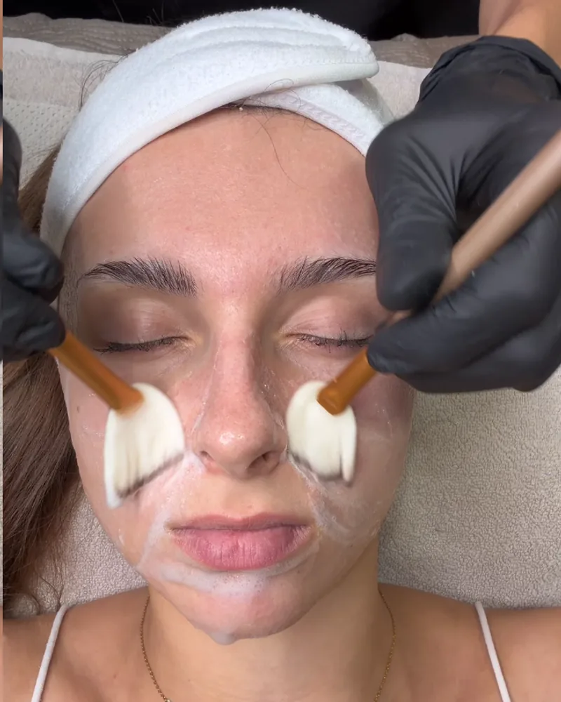Compresses posées sous les yeux pendant l'application d'un peeling chez Oraskin à Lille