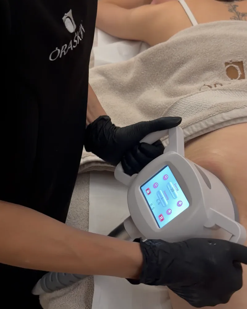 Tête Velashape passée sur la cuisse pendant une séance chez Oraskin à Lille